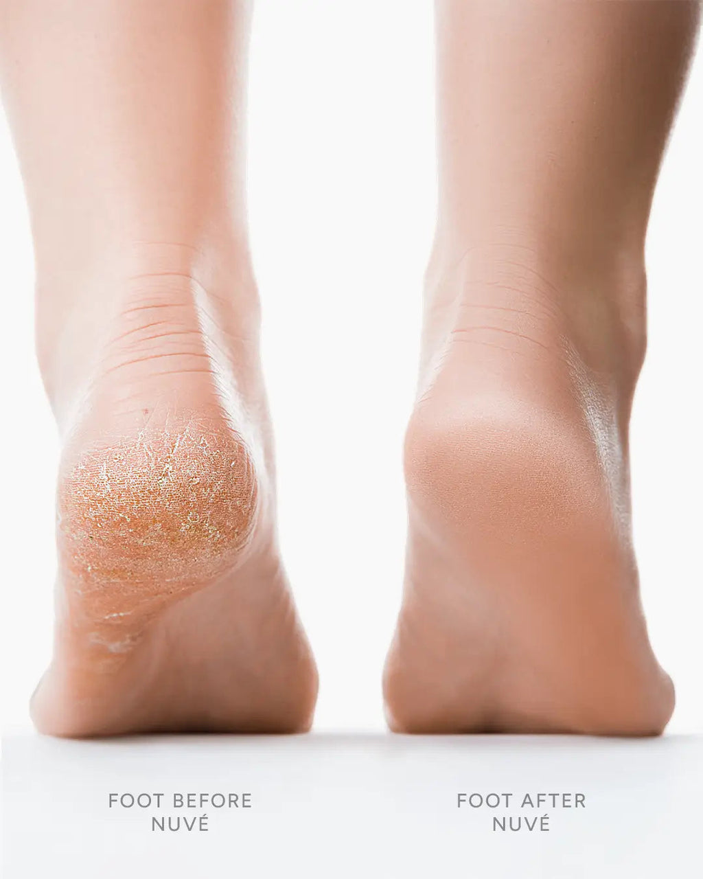 ELECTRIC CALLUS REMOVER Nuve Silk 3 Pro